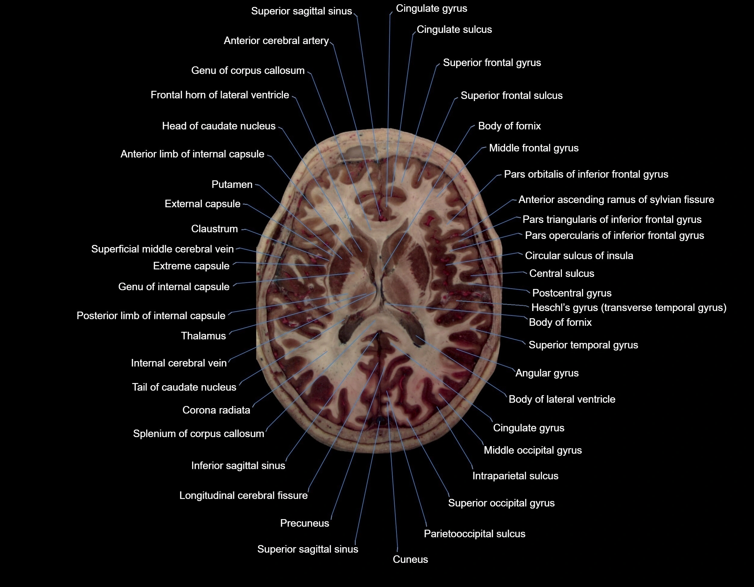 MRI Brain axial cross sectional radiology anatomy 3T image  -img-000046.webp